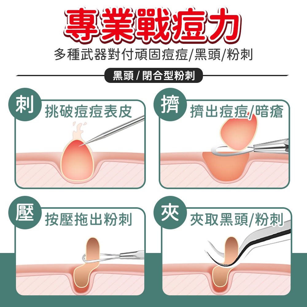 專業戰痘力多種武器對付頑固痘痘/黑頭/粉刺黑頭/閉合型粉刺刺挑破痘痘表皮擠擠出痘痘/暗瘡 按壓拖出粉刺夾夾取黑頭/粉刺