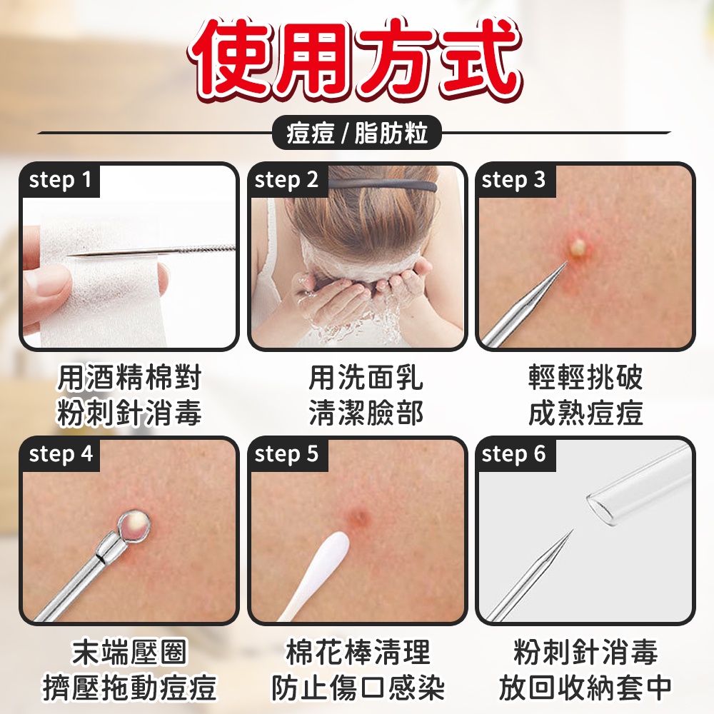 使用方式痘痘脂肪粒step 1step 2step 3用酒精棉對粉刺針消毒用洗面乳清潔臉部輕輕挑破成熟痘痘step 4step 5step 6末端壓圈擠壓拖動痘痘棉花棒清理防止傷口感染粉刺針消毒放回收納套中